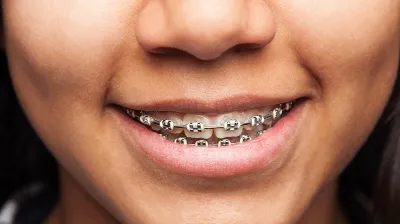 woman smiling with braces
