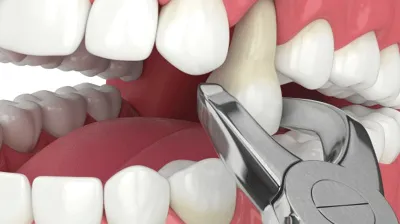 tooth removal process