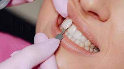 dental veneers process
