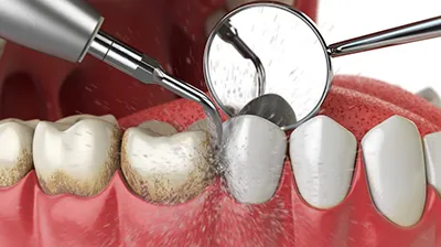 Teeth cleaning process