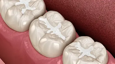 White dental fillings