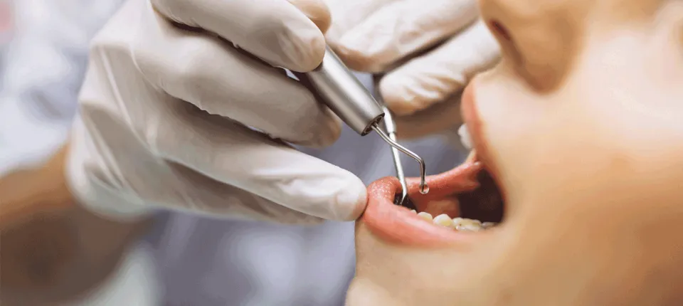 Dental teeth cleaning process