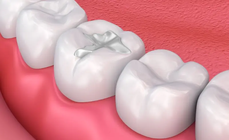 white teeth filling