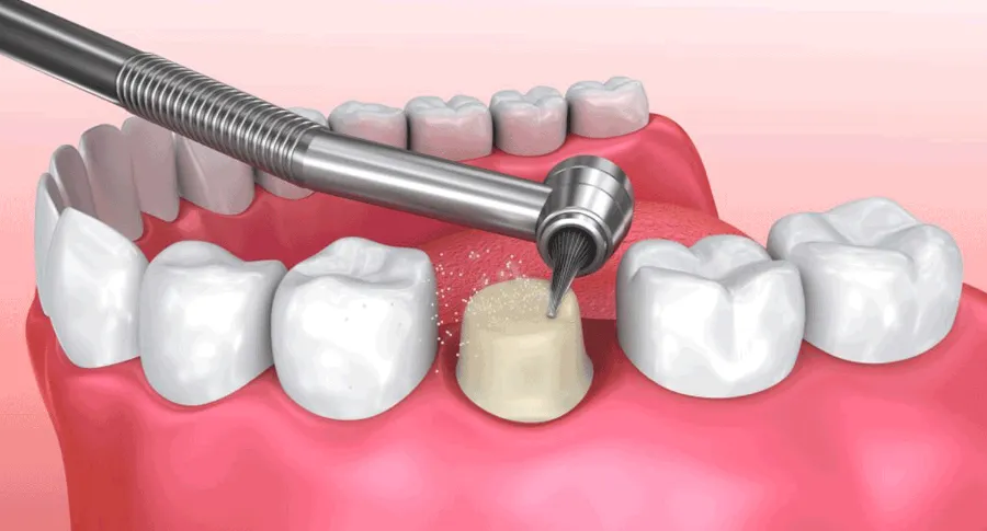 tooth filing for crown installation