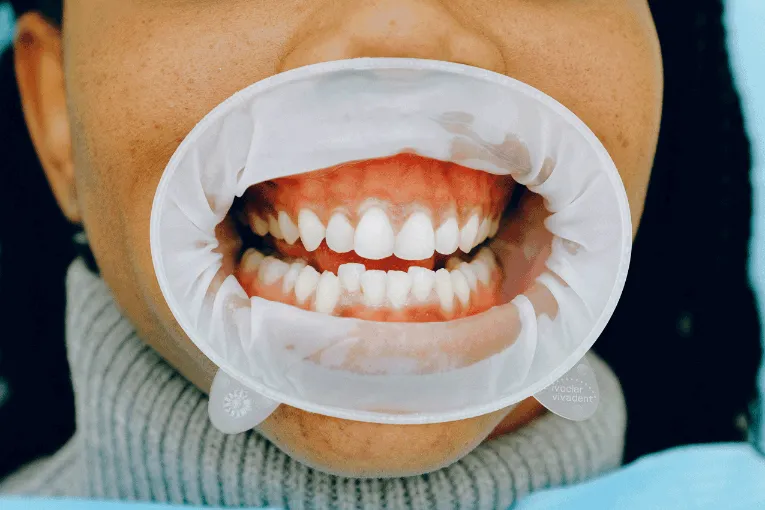 Closeup teeth gum therapy process