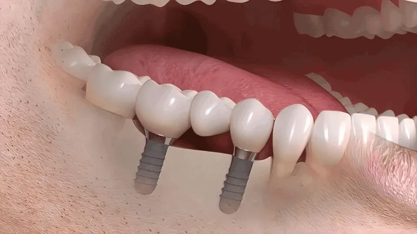 dental bridge concept