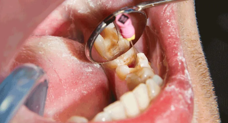 Root Canal process