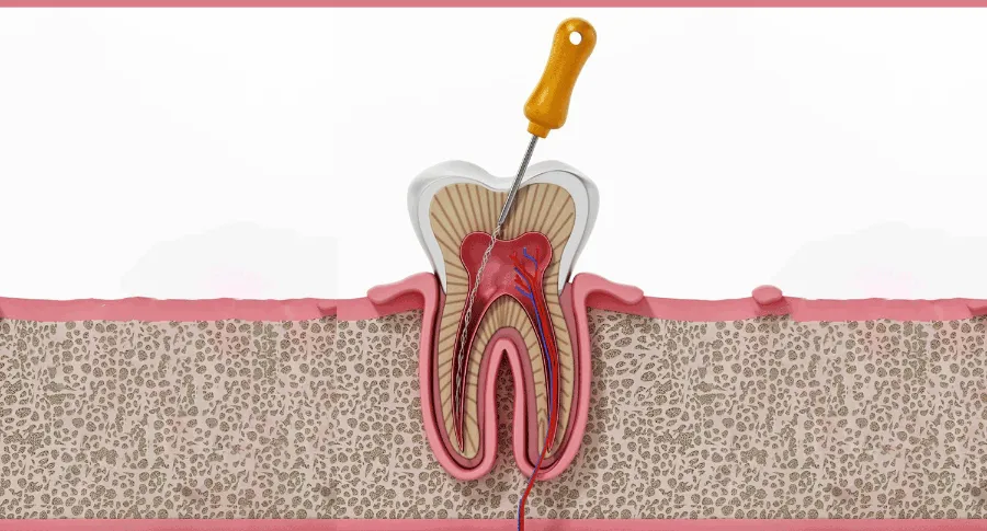 root canal concept