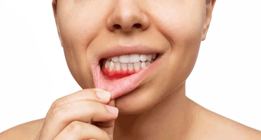 Woman holding lips down to show teeth