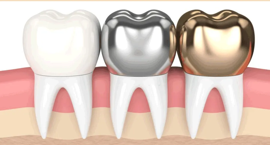 different types of crowns concept