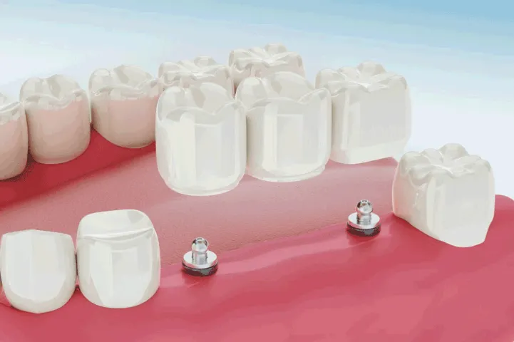 dental bridge concept