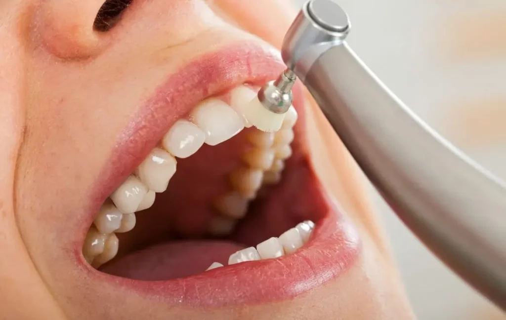 teeth cleaning process
