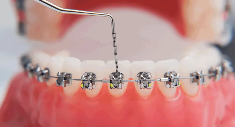 braces installation process