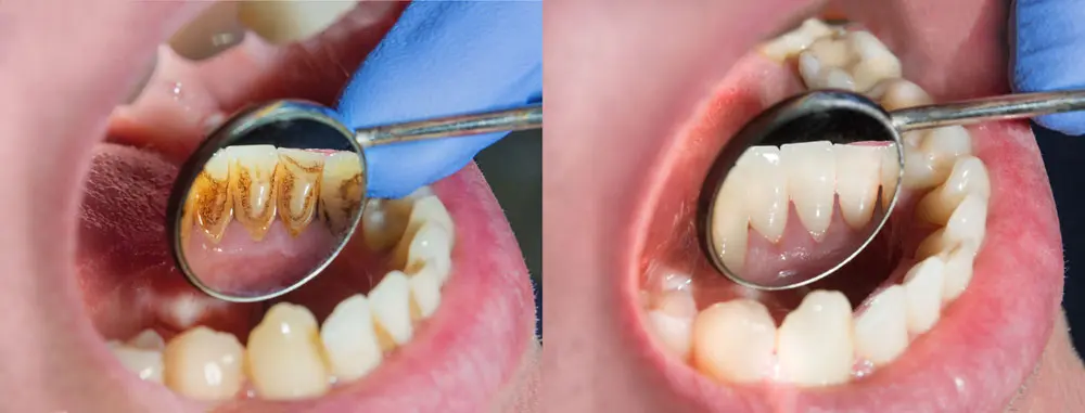 teeth cleaning before and after