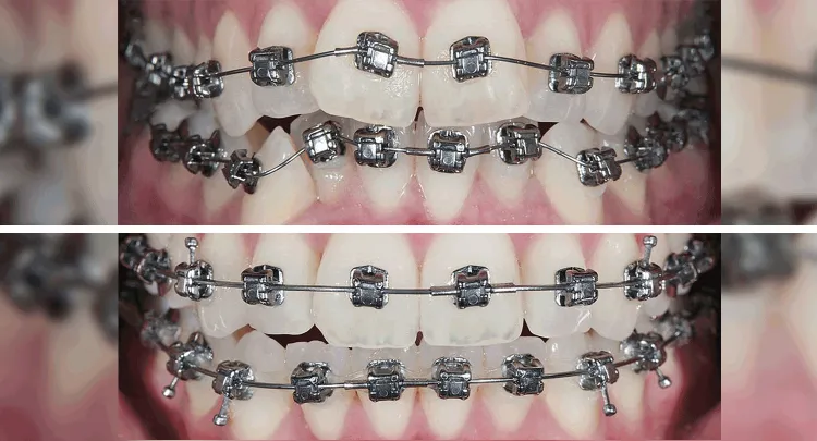 Braces before and after
