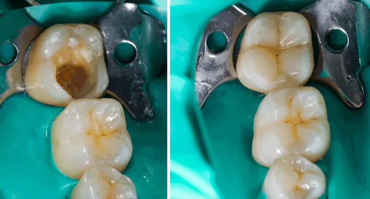 Teeth Filling before and after