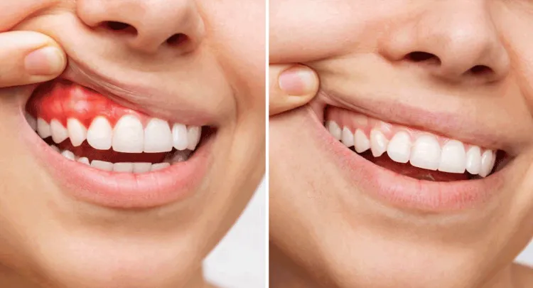 Gum therapy before and after