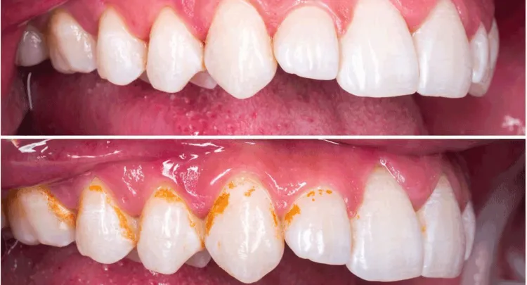 Teeth Cleaning Before and after