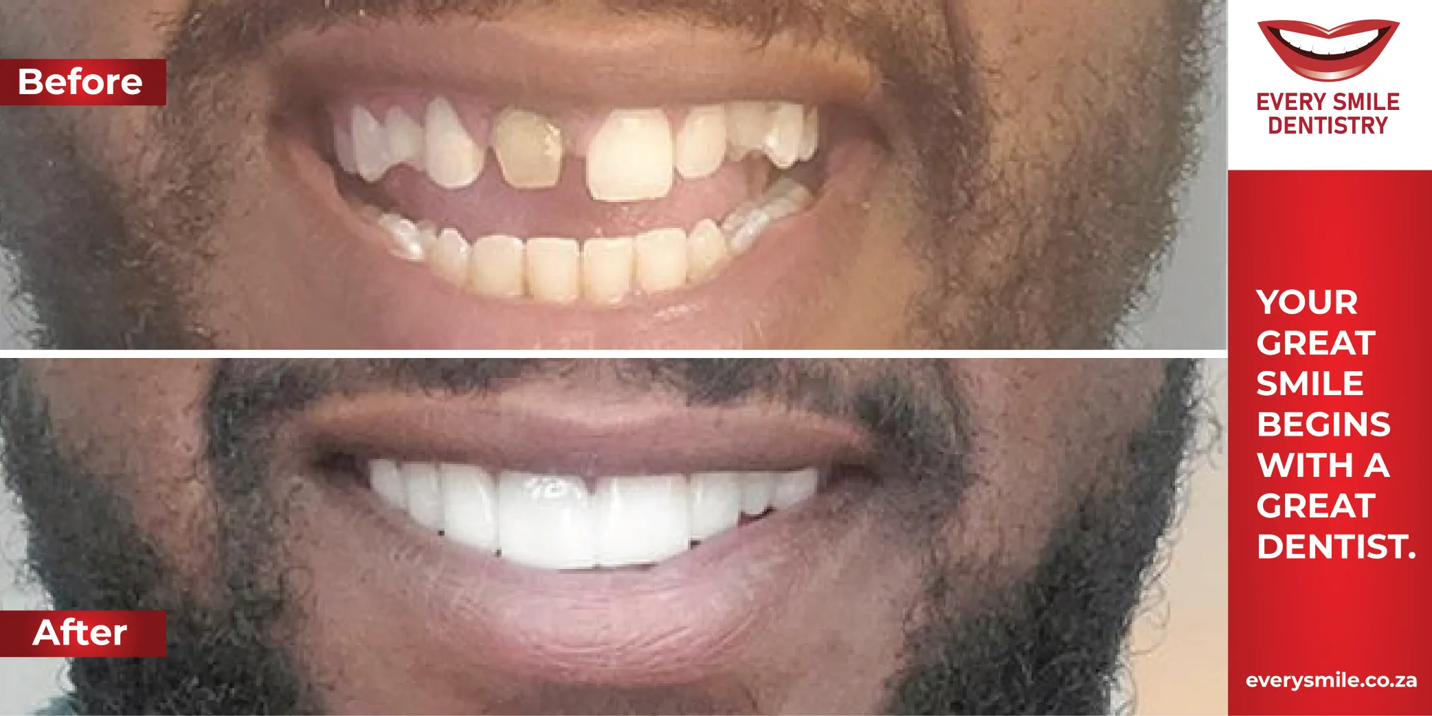 chipped tooth before and after