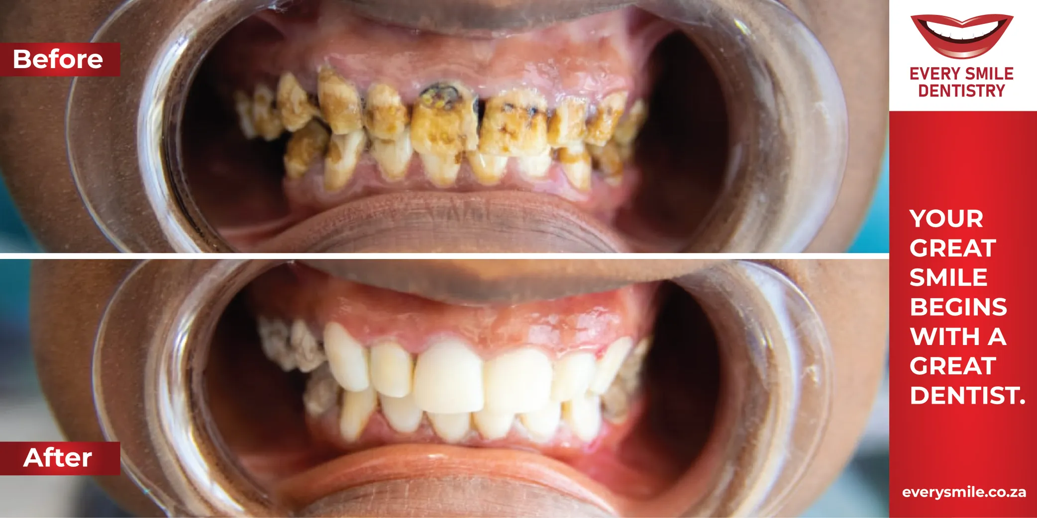 rotten teeth before and after