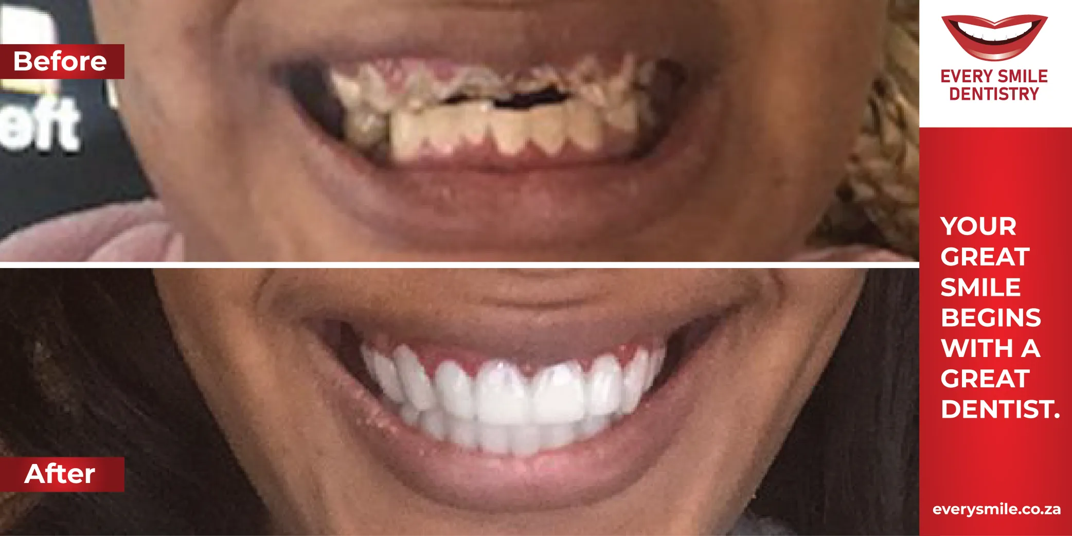 rotten teeth transformation before and after