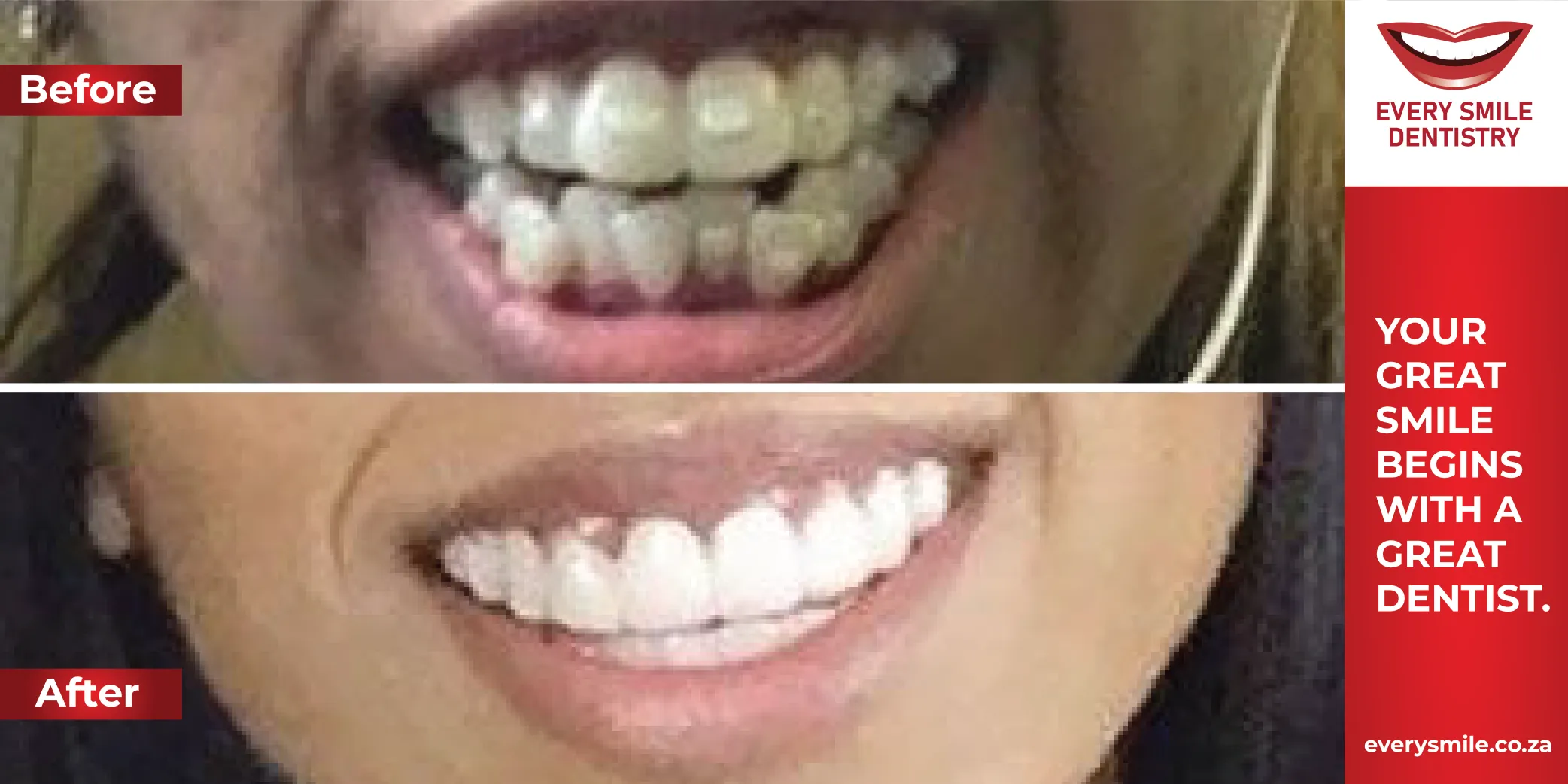 crooked teeth fixing before and after