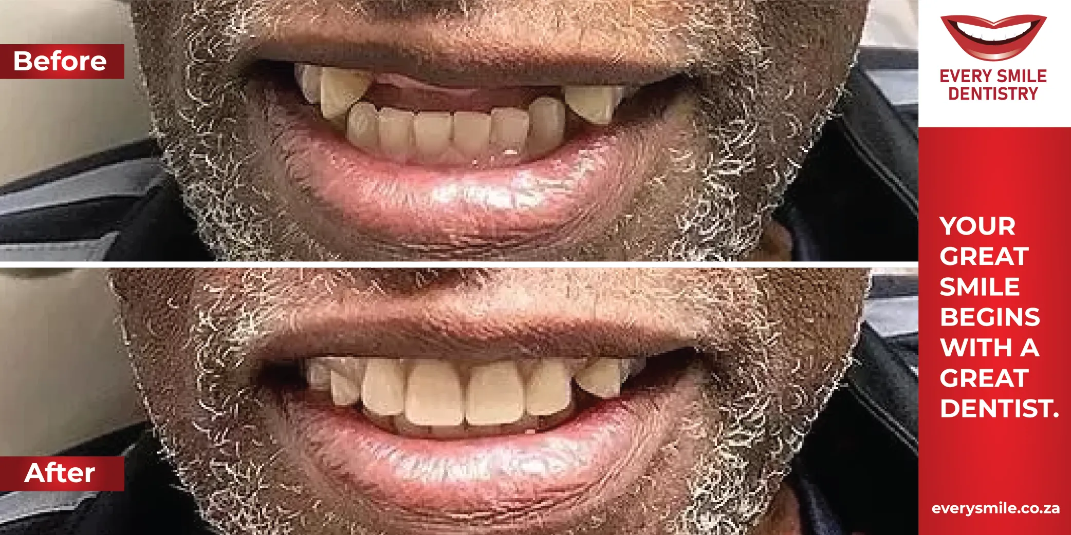 missing front teeth transformation before and after