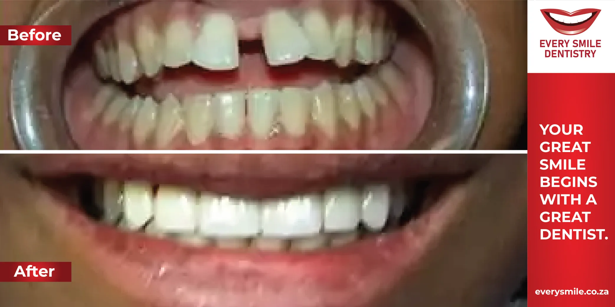 Closing gap transformation before and after
