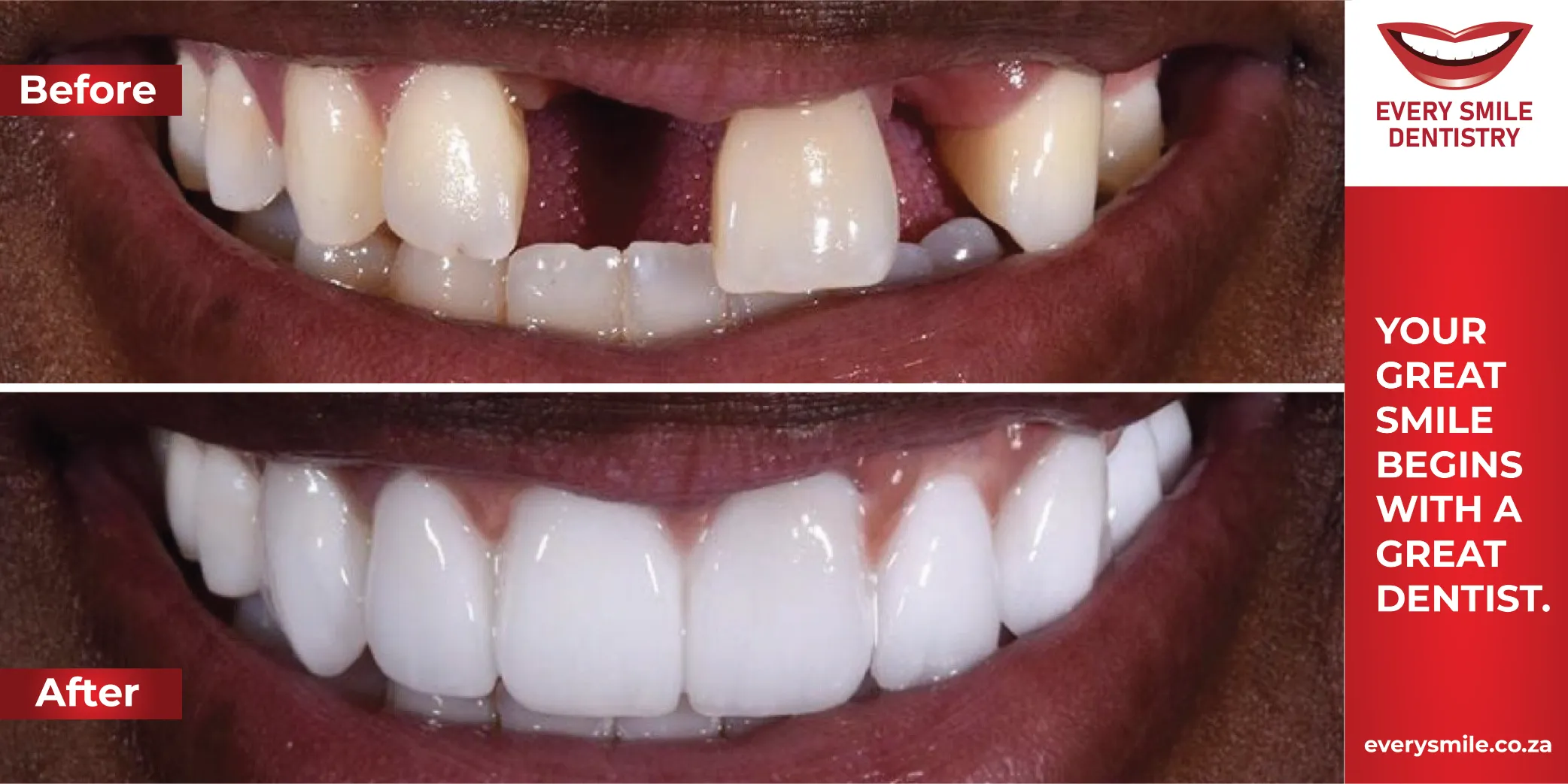 missing teeth transformation before and after
