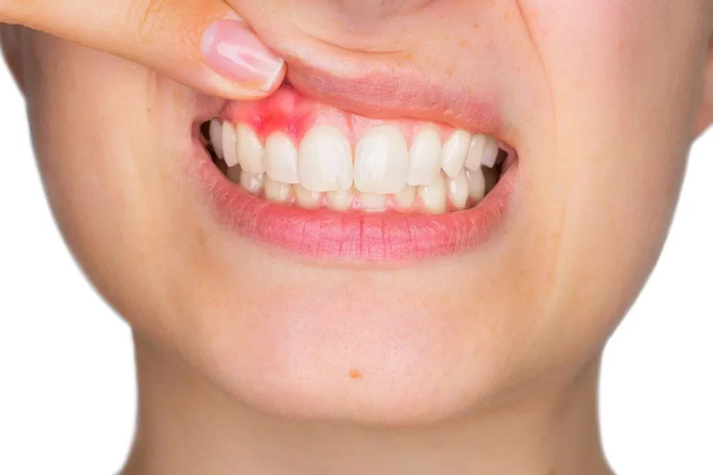 woman showing signs of gingivitis on her mouth
