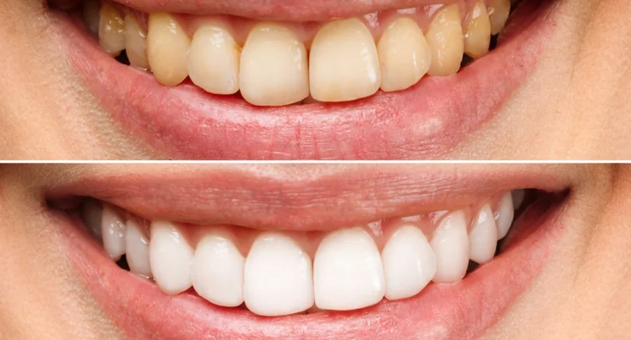 teeth Whitening before and after