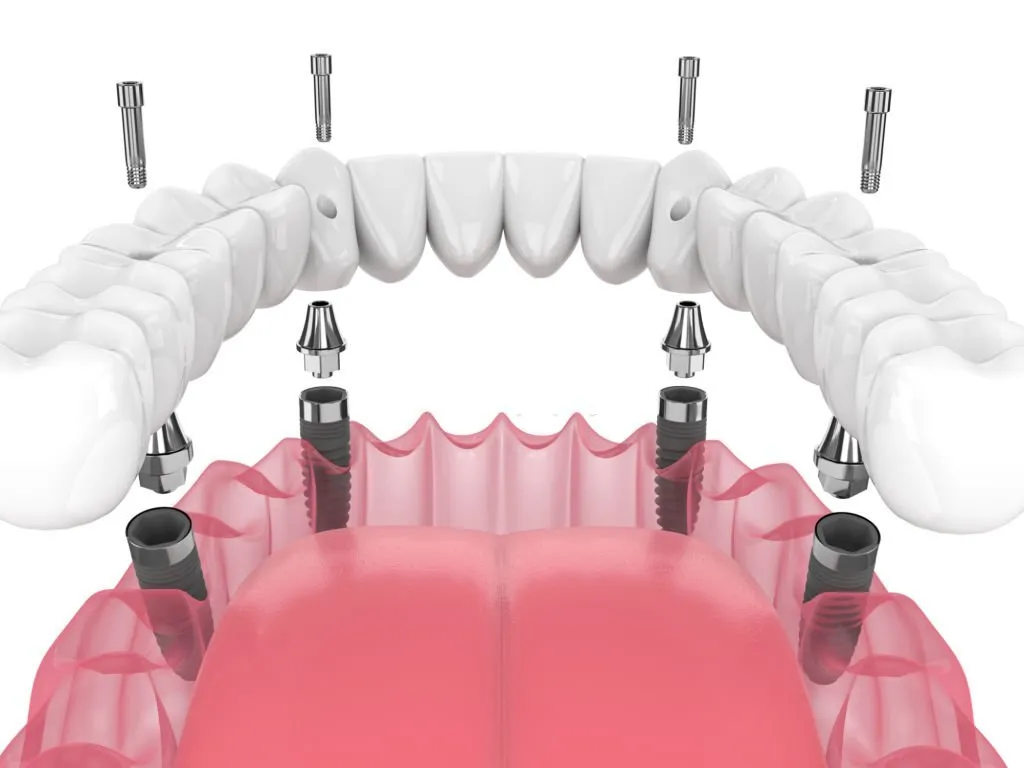 Dental Implants sample