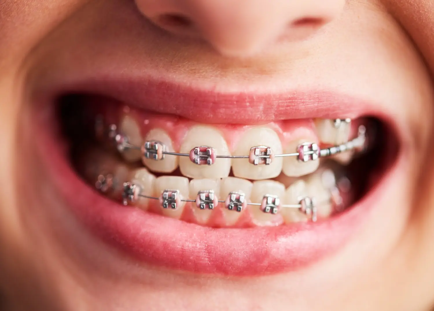 braces image