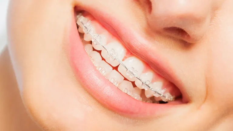 Image of clear braces