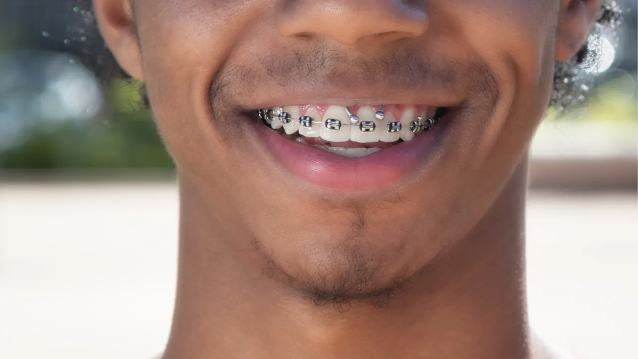 Braces on teeth of African man