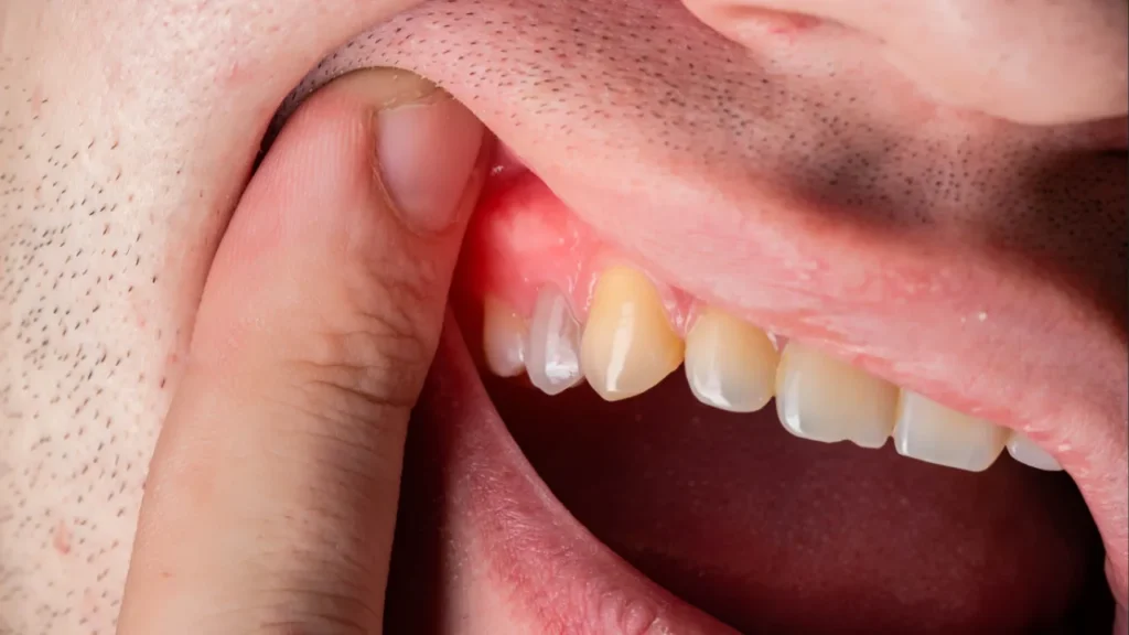 Swollen gums