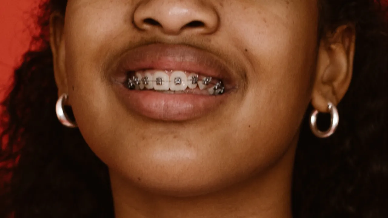 How Much Are Braces In South Africa?